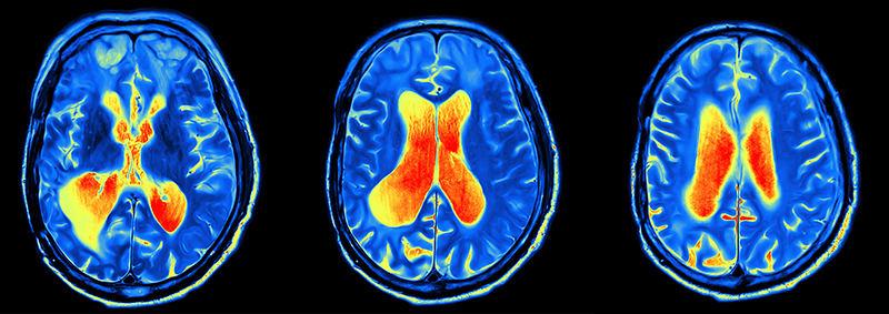 series of three brain scans