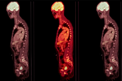 three Pet scans - profiles of human body