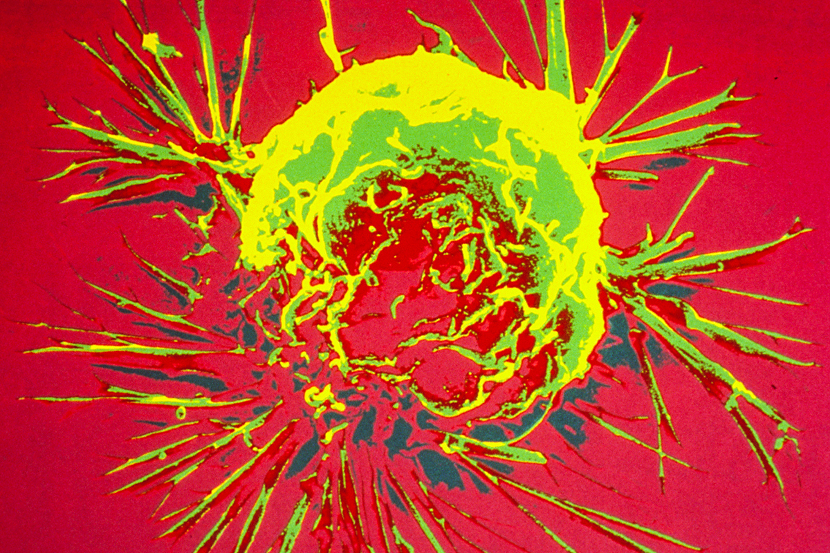A breast cancer cell, photographed by a scanning electron microscope showing overall shape of the cell's surface at a very high magnification