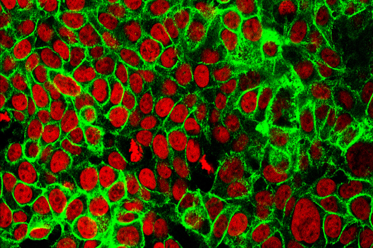 Human colon cancer cells with the cell nuclei stained red and the protein E-cadherin stained green
