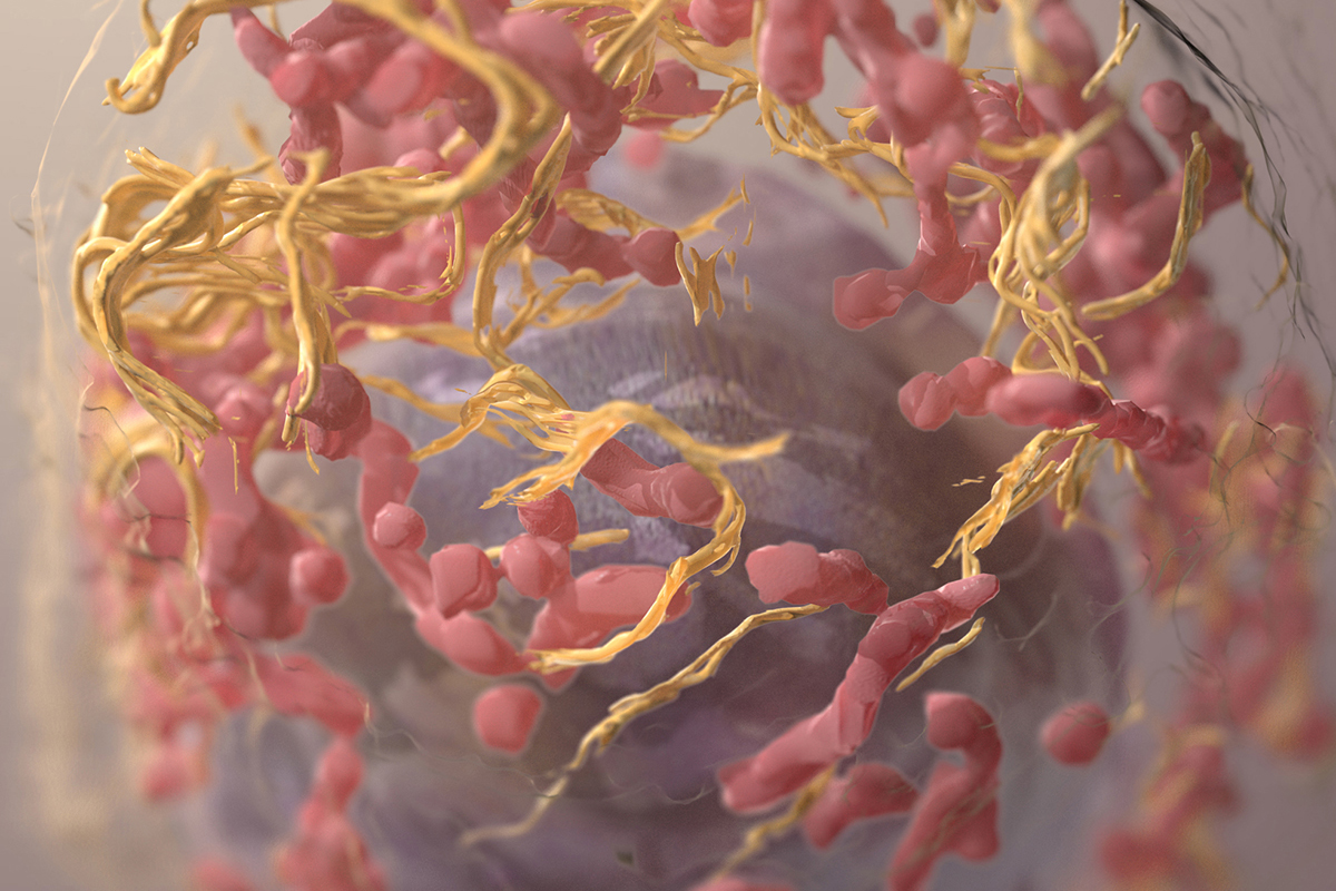 3D structure of a melanoma cell derived by ion abrasion scanning electron microscopy
