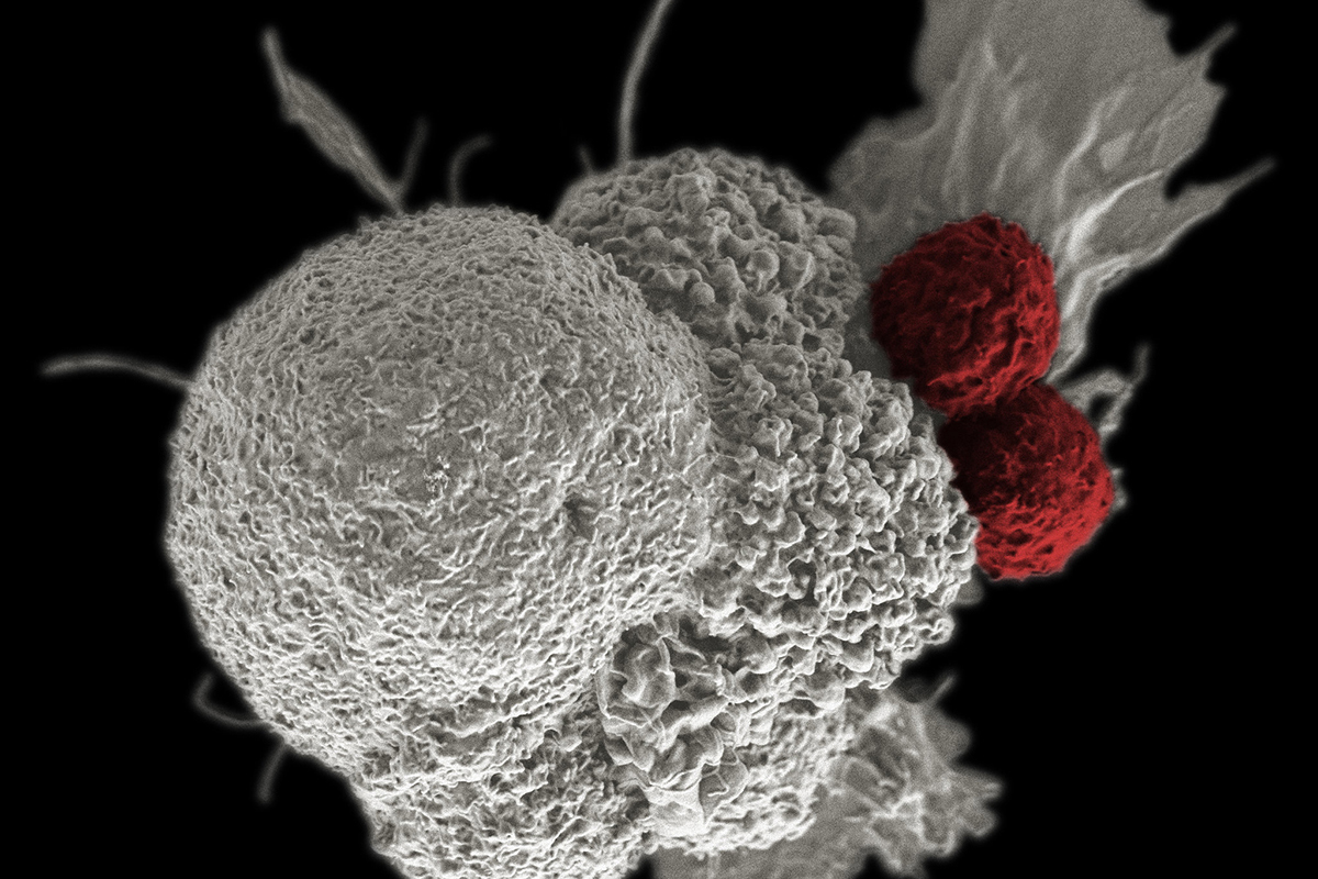 Scanning electron micrograph of an oral squamous cancer cell (white) being attacked by two cytotoxic T cells (red), part of a natural immune response