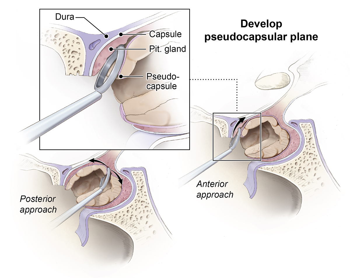 Pituitary adenoma surgery