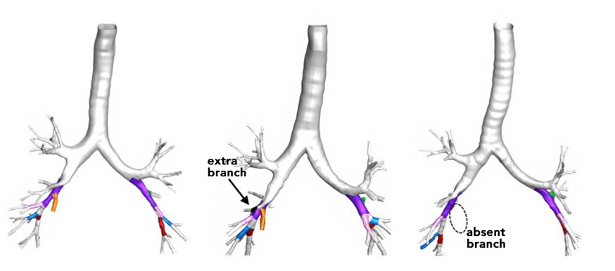 20180130-lungs.jpg