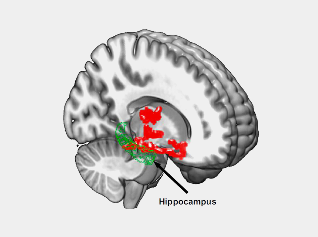 20180424-beta-amyloid-brain-regions.jpg