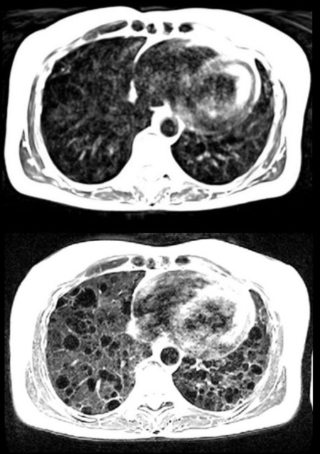20191022-nhlbi-lung.jpg