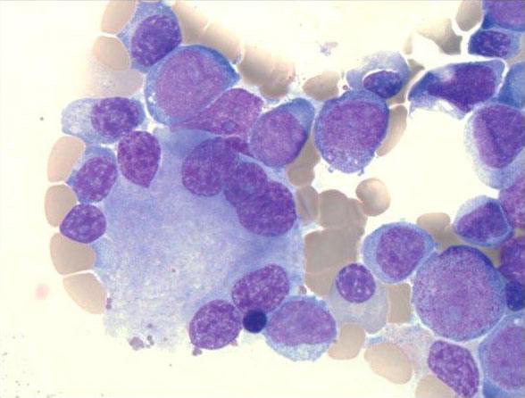 Dysplasia and myeloblasts in the bone marrow of a NIH patient with MDS/AML (Image Credit: K.Calvo).