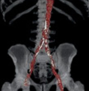 20200317-aortic-calcification.jpg