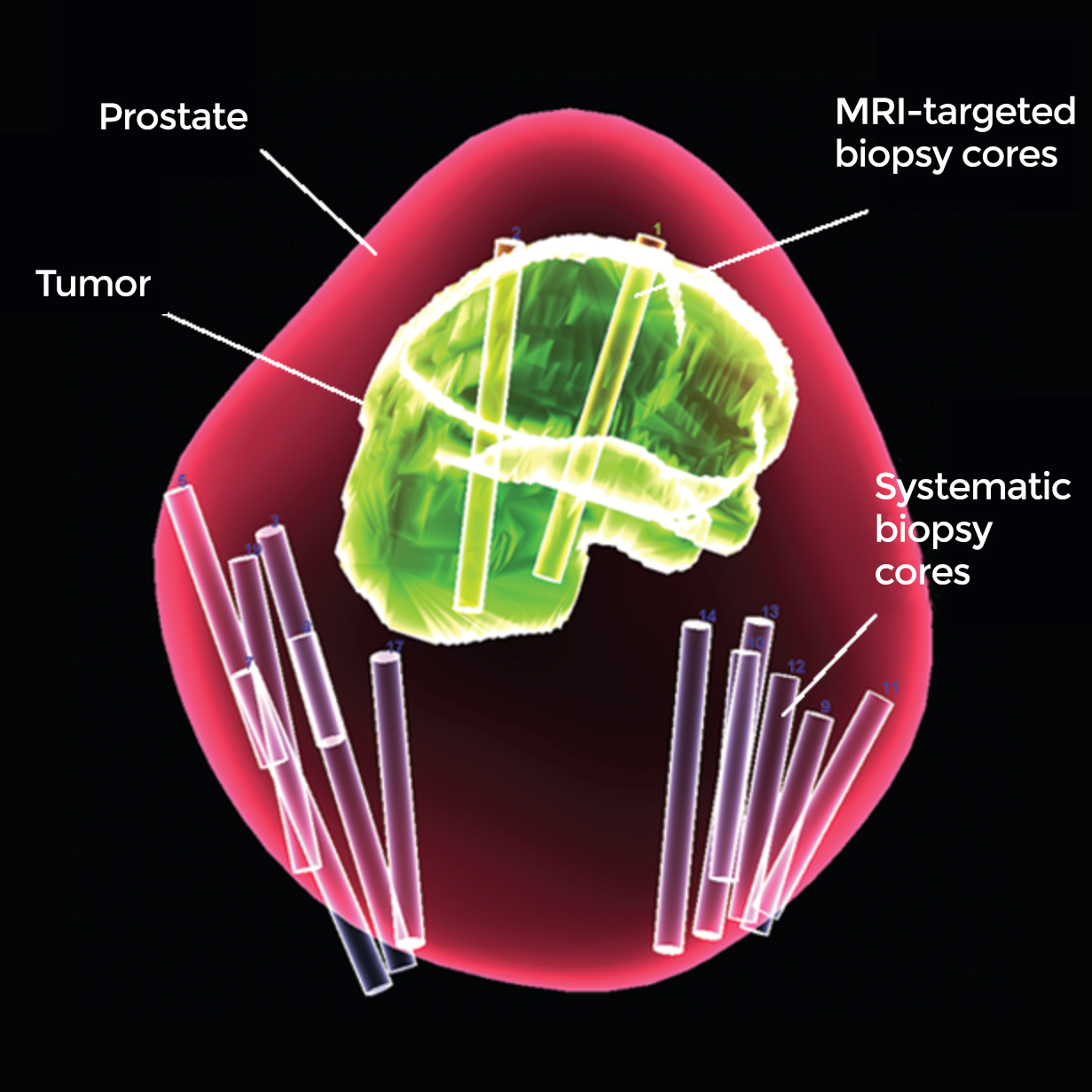 20200317-prostate-3d.jpg