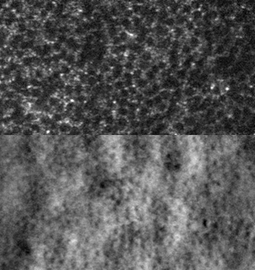 Widespread dark cones identified in a patient with oligocone trichromacy
