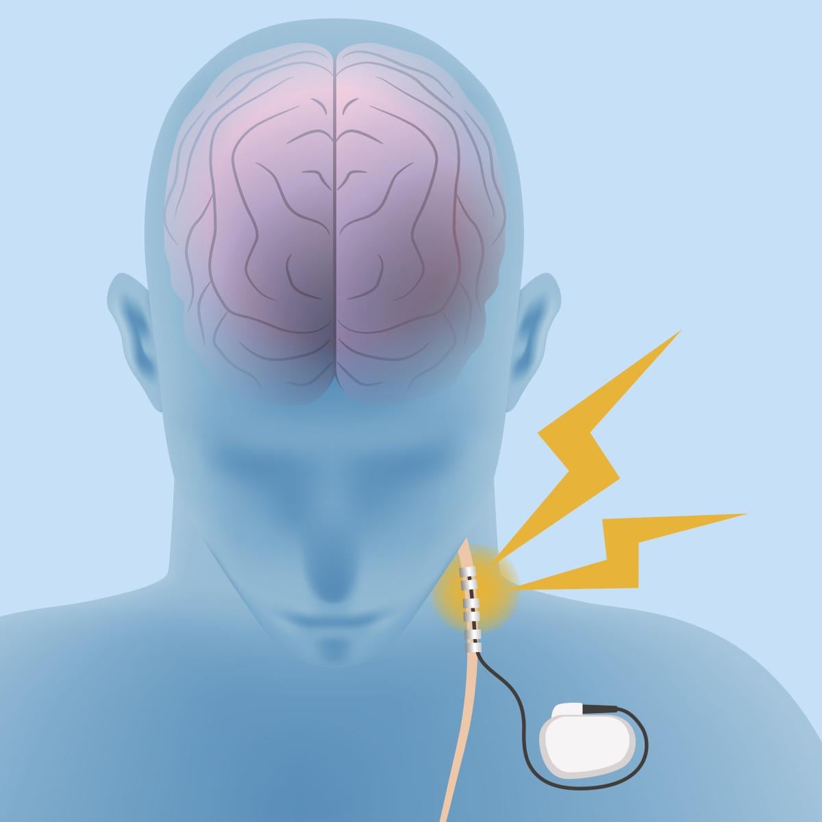 Man neuromodulation therapy - 656606974.jpg