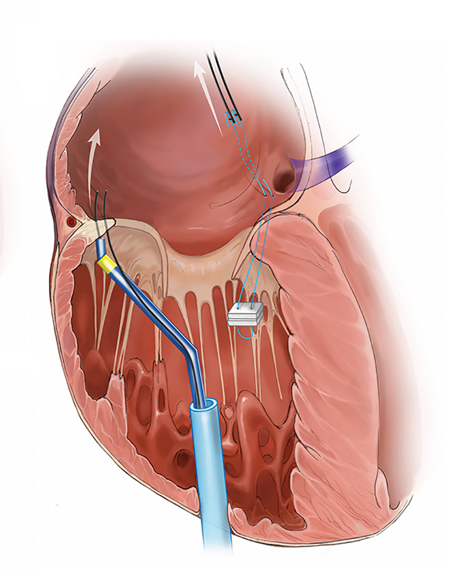 Pledget-assisted suture tricuspid annuloplasty procedure 