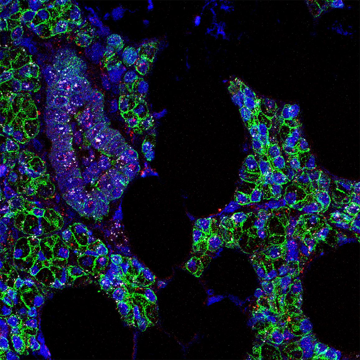 Salivary gland cells infected with SARS-CoV-2.