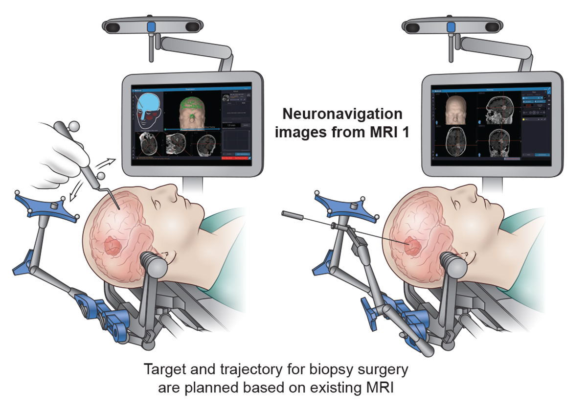Stereotactic biopsy