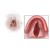 An image depicting cleft palate in a baby.
