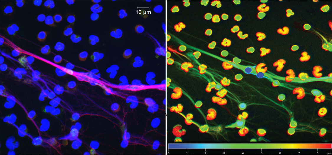 Lupus neutrophils form NETs and extrude nucleic acids