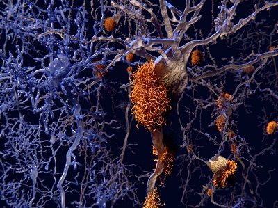 Neurons with amyloid plaques