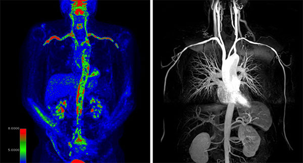 Three images visualizing vasculitis in a patient.