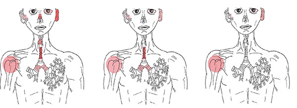 Three images visualizing vasculitis in a patient.