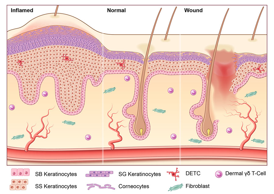 Illustrated cross-section of inflamed, normal and wounded skin.