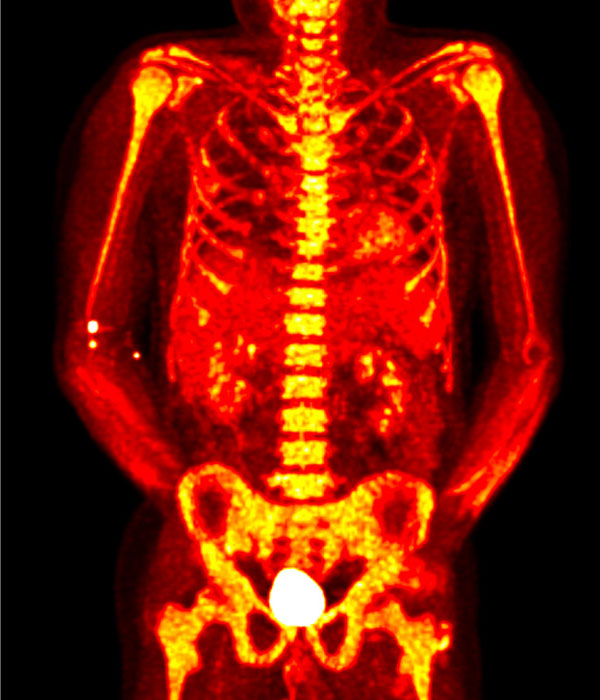 F-fluorodeoxyglucose positron emission tomography in a patient with VEXAS syndrome demonstrating hypermetabolic activity in bone marrow (yellow).