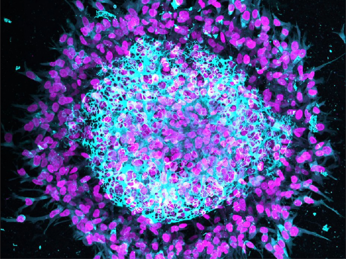 Yamada cancer cell spheroid.
