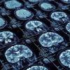 Photo of multiple brain images from MRI scans.