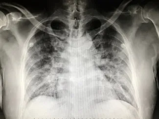 X-ray of the human lung. 