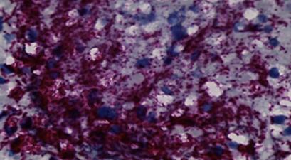 Fusobacterium nucleatum bacteria (purple) in a human colorectal cancer tumor. | Fred Hutchinson Cancer Center | NINDS