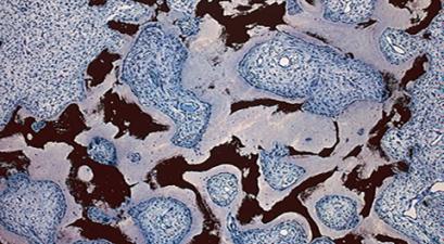 Fibrous dysplasia/McCune-Albright research offers hope, answers.