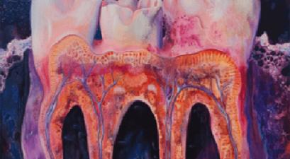 Compared to healthy gum tissue (left), chronic periodontal disease (right) is marked by a buildup of unhealthy bacteria and large numbers of immune cells, leading to severe inflammation and bone loss. ǀ NIDCR/NIH