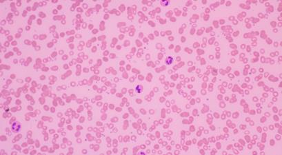 A microscopic view of red blood cells on a pink background with a few purple-stained white blood cells visible.