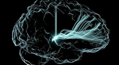 Deep Brain Stimulation Illustration