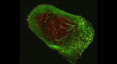 Human malignant melanoma cell viewed through a fluorescent, laser-scanning confocal microscope.