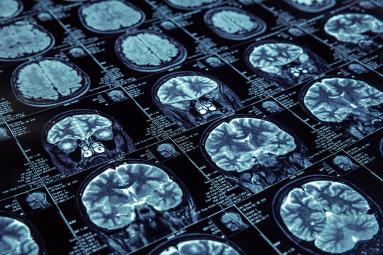 Photo of multiple brain images from MRI scans.