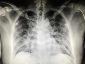 X-ray of the human lung. 