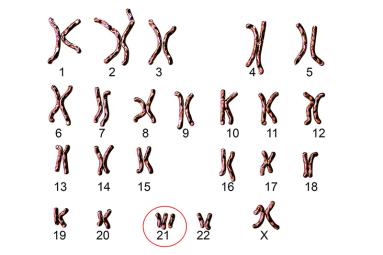 chromosomes chart showing trisomy 21